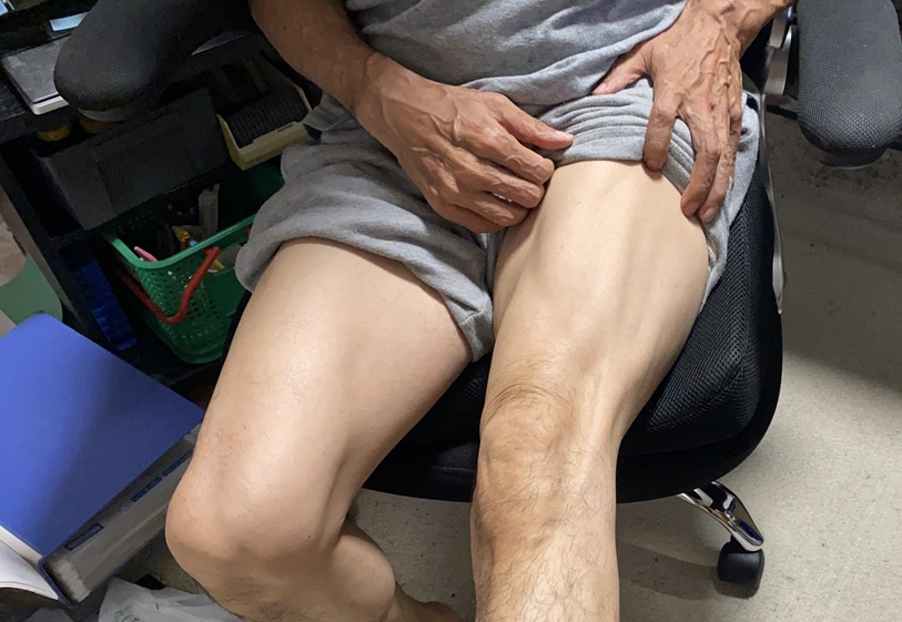大腿四頭筋
