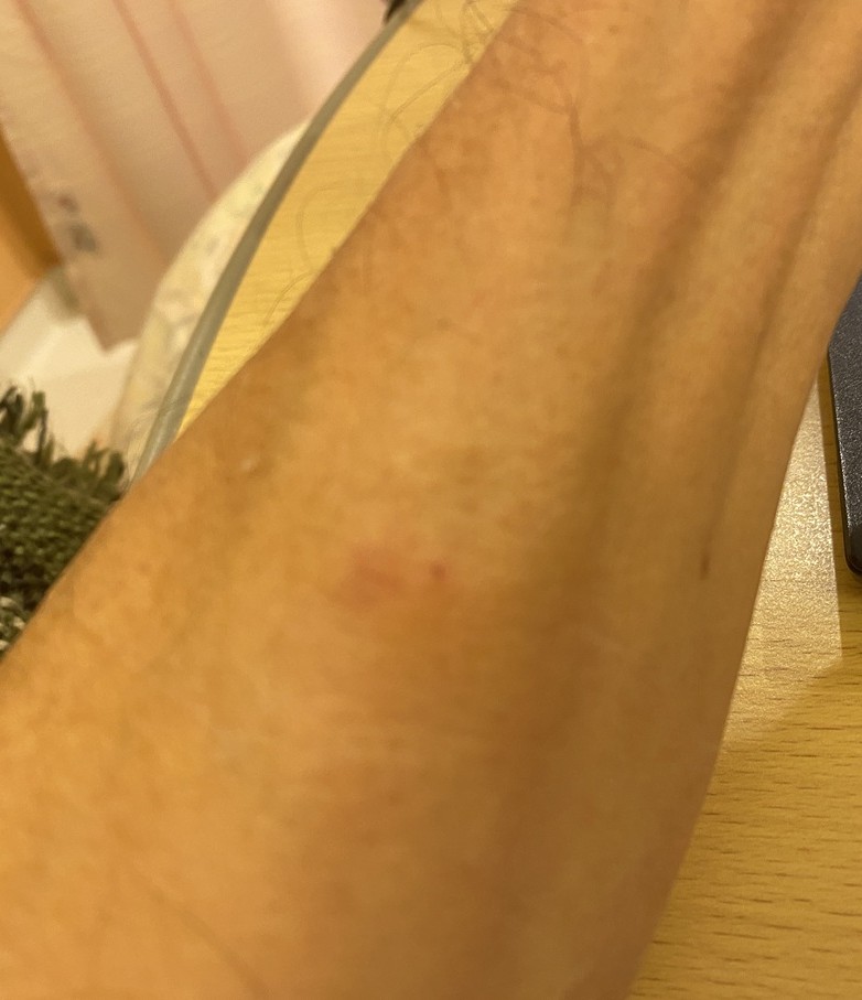 「入院中に使用していた点滴の針が抜かれたあとの腕の様子。うっすら赤みが残り、ようやく自由に動かせるようになった瞬間の記録。」